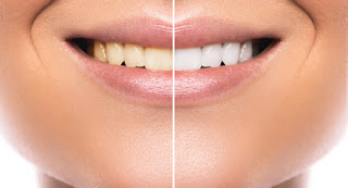 Top tips for Teeth whitening at home