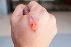 How to treat a burn blister that has popped