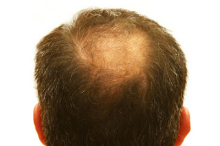 Causes-Symptoms-Types-Hair-Loss