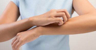 What Are The Three Types Of Eczema?