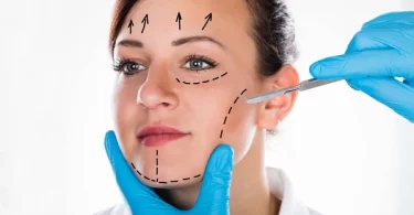 Overview of the Endoscopic Facelift Procedure